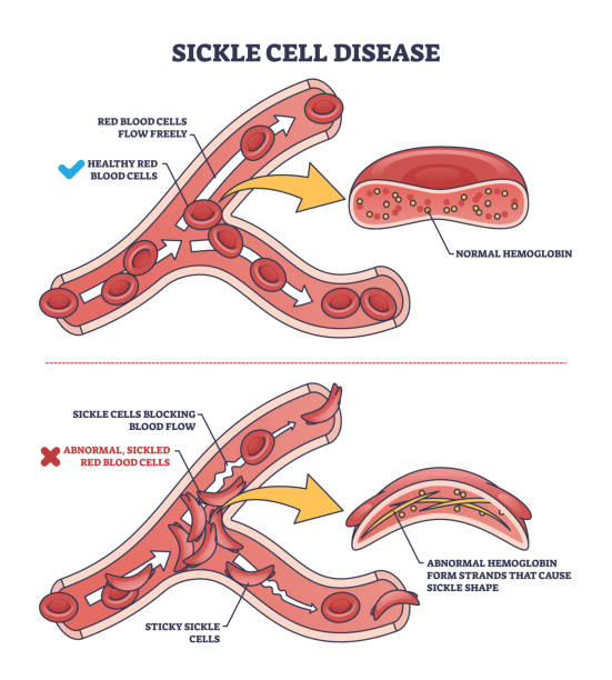 Sickle Cell Disease Treatment